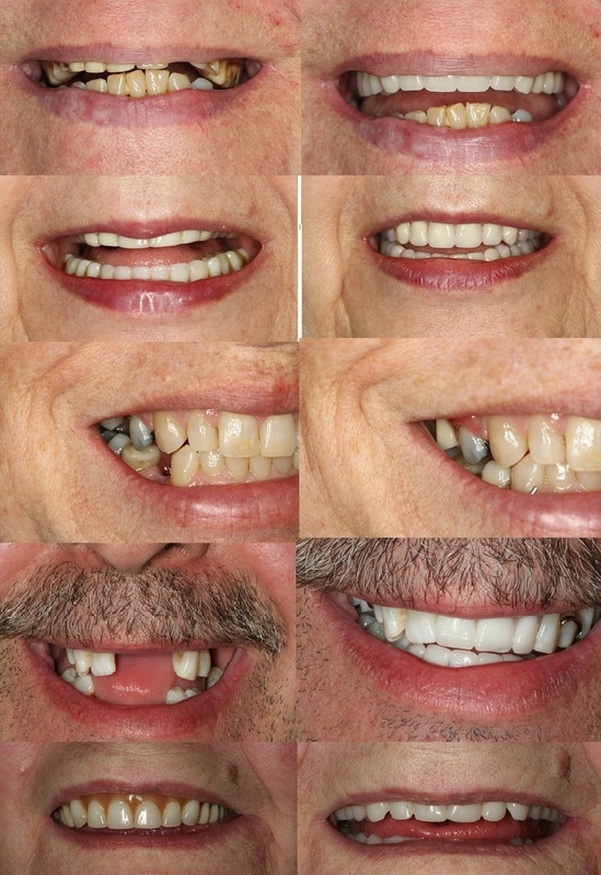 Dentures Ottawa Denture